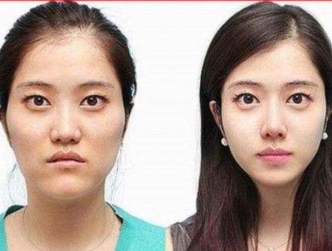 韩国的整容术